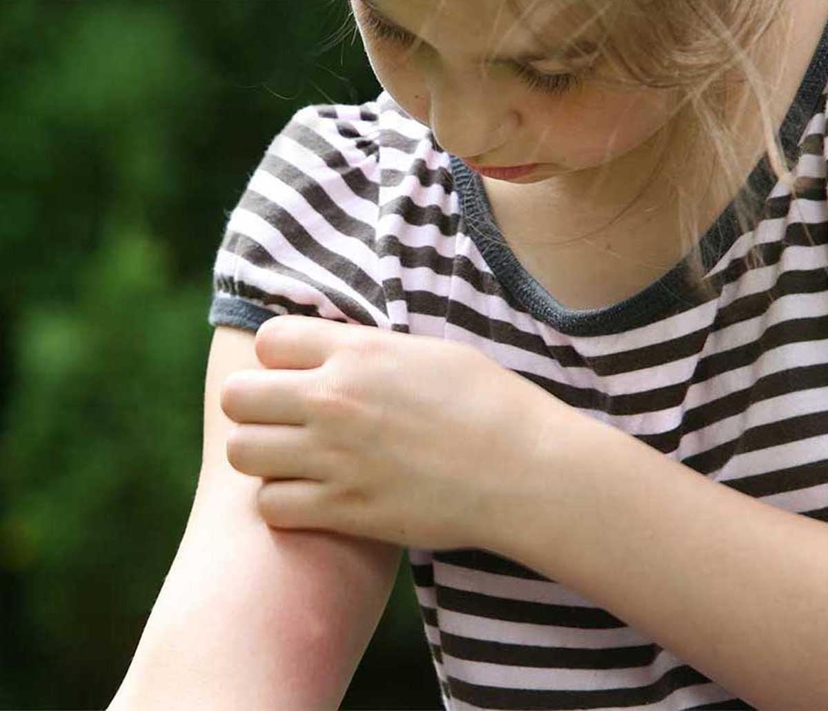 mosquito-control-square A young girl scratching a bug bite on her arm
